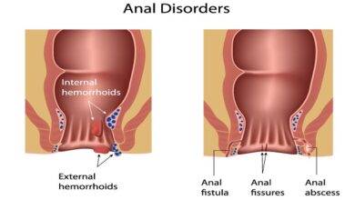 Anal Fissures Pregnancy